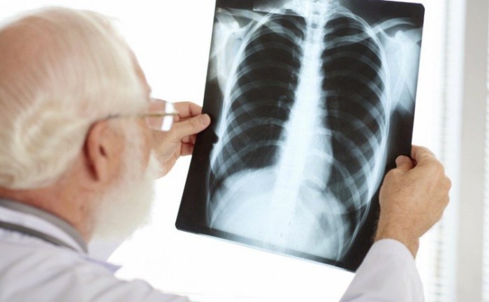 Saúde chama atenção para a prevenção à tuberculose