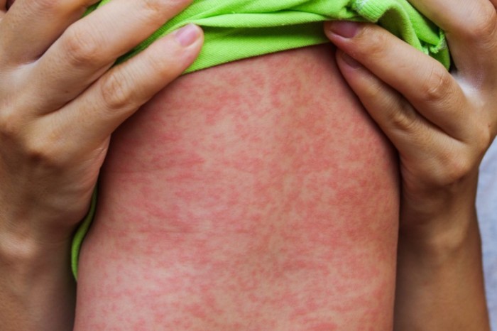 Vigilância Epidemiológica emite alerta sobre o sarampo e reforça importância da vacinação contra a doença