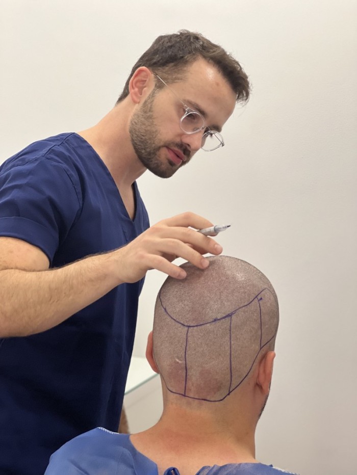 FUE é o transplante capilar mais realizado entre os homens