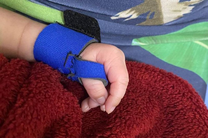 Em trabalho inédito, HRAS desenvolve órteses de neoprene para recém-nascidos