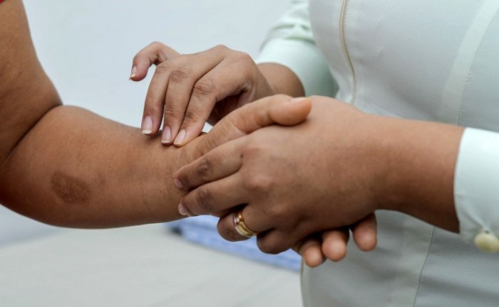 SES-TO alerta para a prevenção e os cuidados contra a Hanseníase