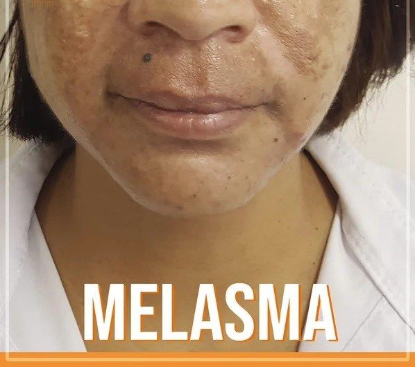 Revibela Para Melasma