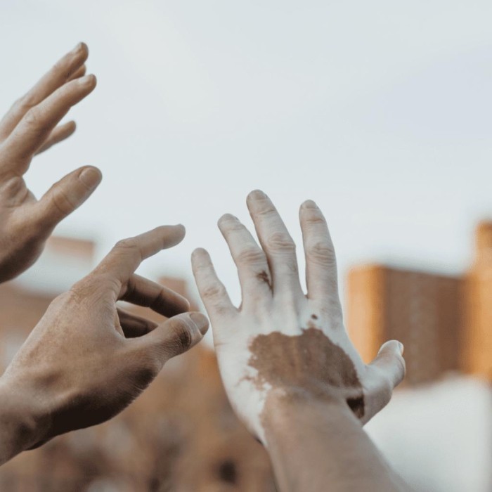 Vitiligo: SES-AM faz alerta para alto número de casos no estado 