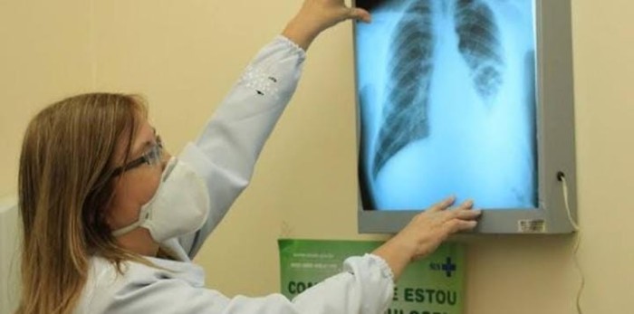 Dia Nacional de Combate à Tuberculose: SES-AM esclarece sobre meios de prevenção, sintomas e tratamento