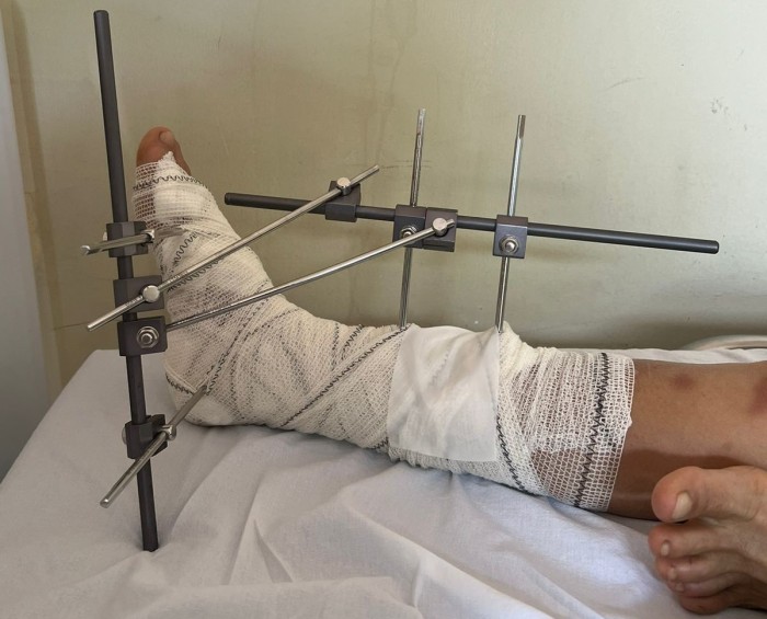 Hospital de Catolé realiza cirurgia ortopédica de urgência e evita transferência de paciente para outra cidade