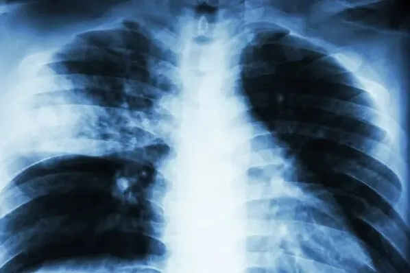 Tempo seco e grande amplitude térmica são fatores que favorecem o aumento de doenças respiratórias (Foto: Shutterstock)