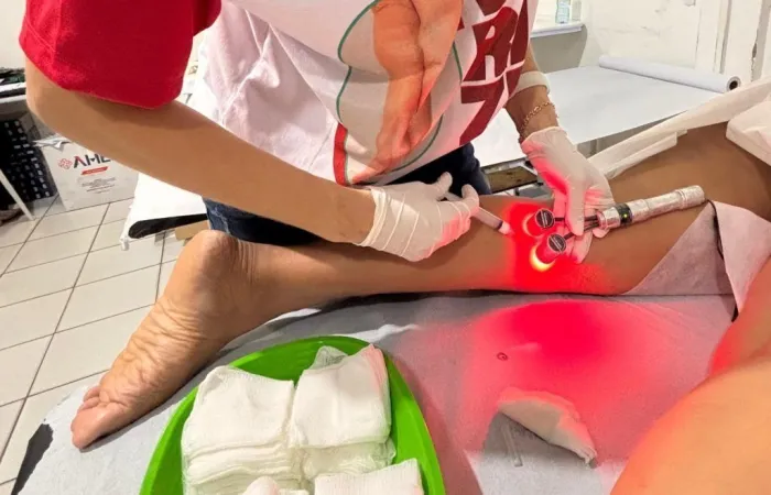 Programa de tratamento de varizes da Sesapi já beneficiou mais de 100 mulheres em Piripiri