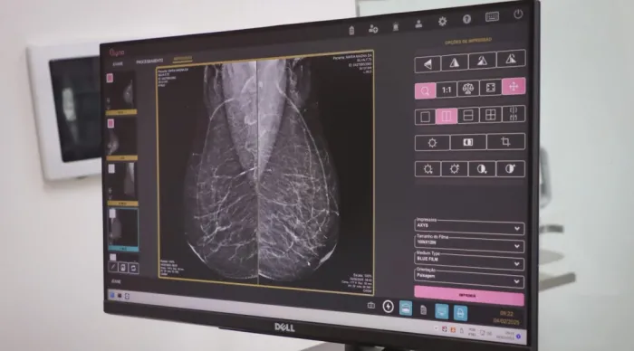Saúde reforça importância do exame de mamografia para diagnóstico precoce do câncer de mama