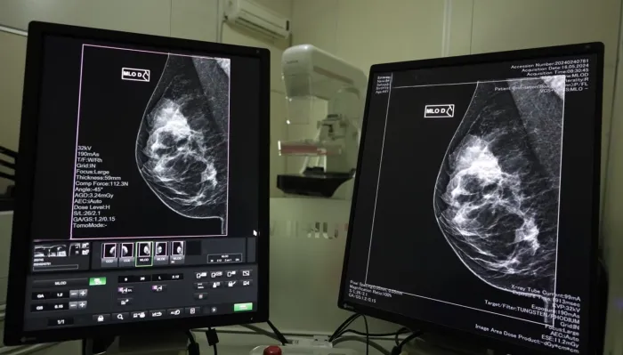 Governo do Estado lança mutirão de mamografias no mês da Mulher 