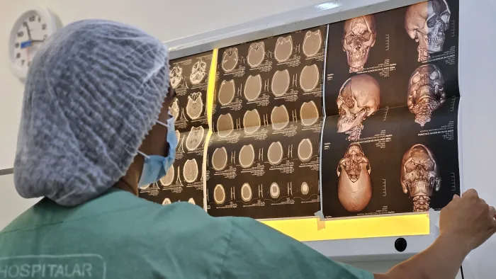 Governo realiza cirurgia inédita de cranioplastia com prótese feita em 3D no Hospital Regional de Caxias