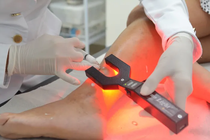 Governo expande tratamento contra varizes para Policlínica de São José de Ribamar