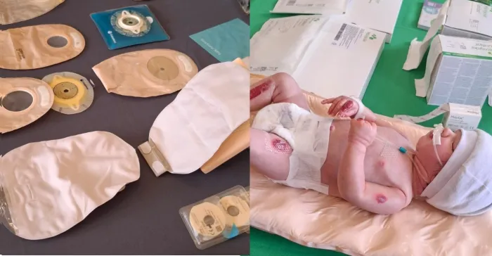 Saúde SC abre inscrições para capacitação de profissionais no atendimento de pessoas com Estomias e Epidermólise Bolhosa em Lages