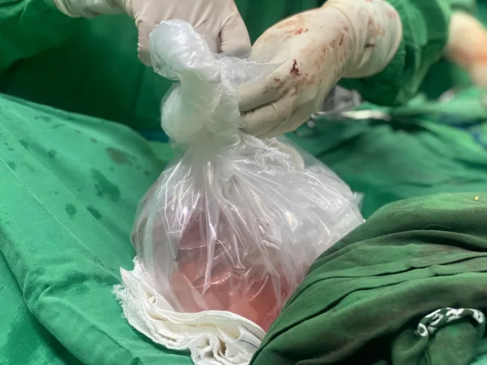 Paraíba zera fila de transplante de coração após doação múltipla no Trauma de João Pessoa