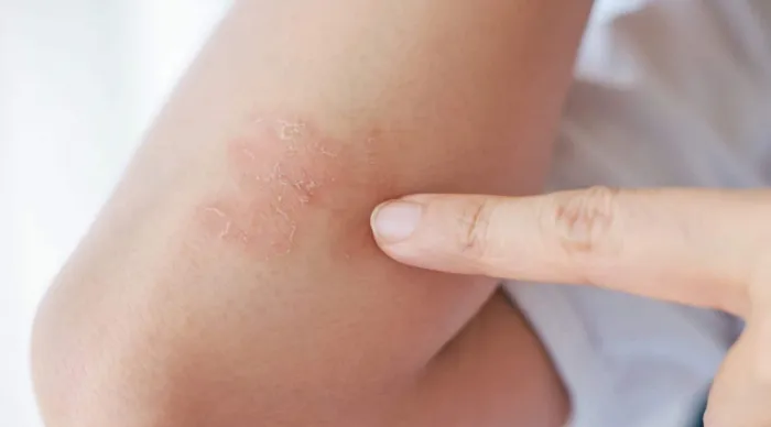 Ipesaúde alerta beneficiários para manutenção do tratamento da psoríase