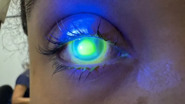 Oftalmologista do HGE alerta sobre o cuidado com os olhos durante o Carnaval