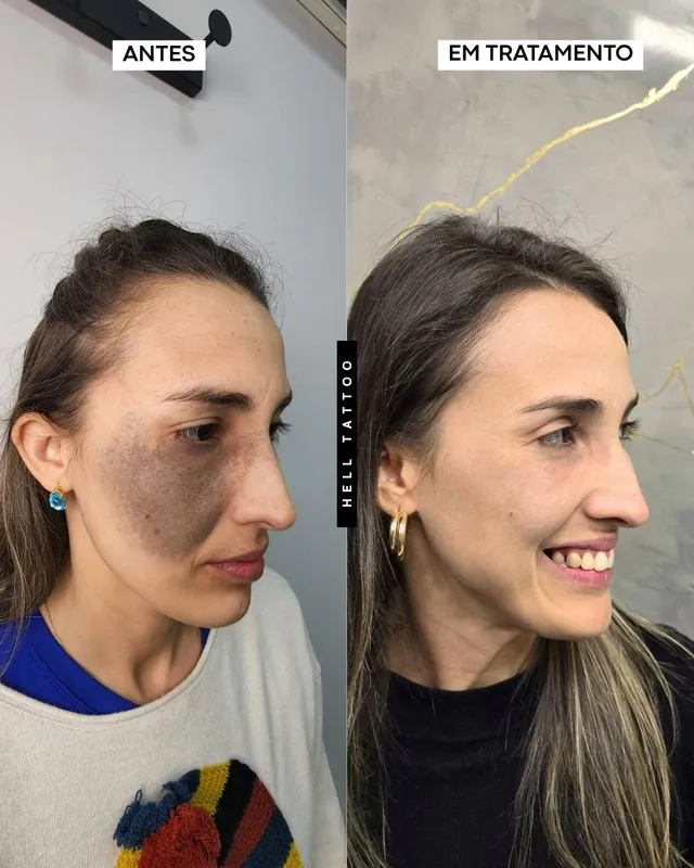 Nevo de Ota pode ser tratado com laser, explica biomédico